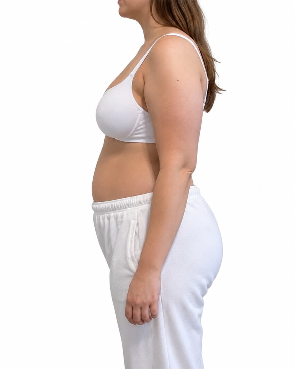Karın Germe (Abdominoplasti) — Öncesi
